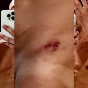 含泪讲述在台湾被两次迷奸，香港男星王喜发伤痕照片